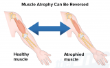 آتروفی عضلانی